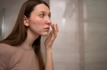 Rosacea