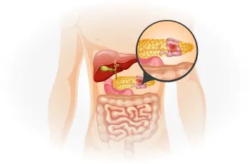 Understanding Pancreatitis