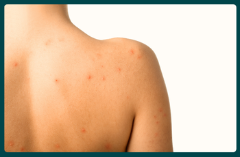 How to get rid of back acne? Doctor-approved remedies