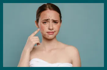 Hormonal acne: What is it and how can you treat it at home