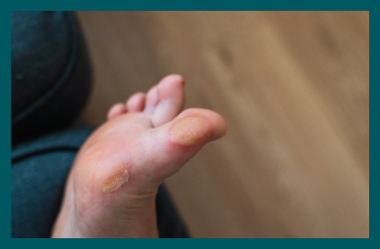 Diabetic foot ulcers: understanding, preventing, and managing the risks