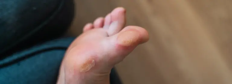 Diabetic foot ulcers: understanding, preventing, and managing the risks
