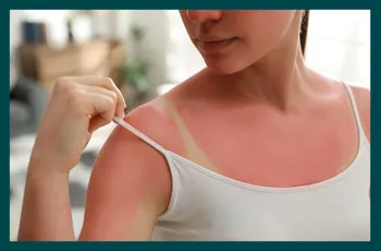 How to heal sunburn - GP-approved tips