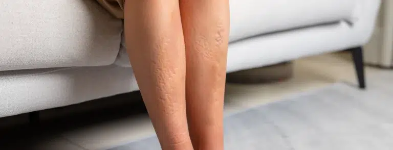 What causes dry skin on legs & face 